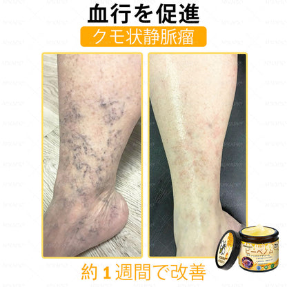✨💜💜APKAPK® 𝗠É𝗛𝗠É𝗥𝗘𝗚 総合クリーム🥇 皮膚の隆起に対するケアには以下が含まれます： 加齢によるシミ、傷跡、いぼ、皮膚の隆起、脂肪の塊、ニキビ、湿疹、乾癬、反転性ニキビ、しわ、皮膚の老化およびその他の問題🔥