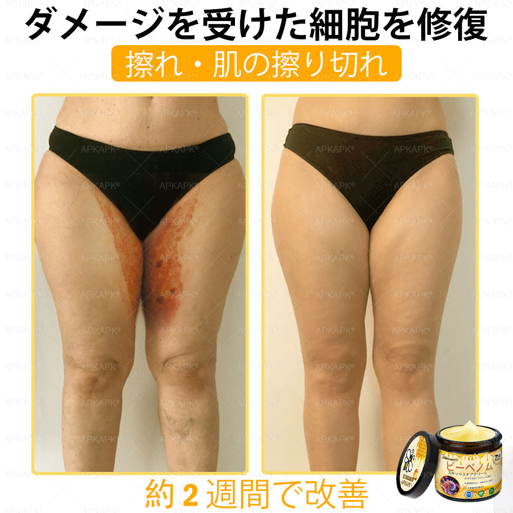 ✨💜💜APKAPK® 𝗠É𝗛𝗠É𝗥𝗘𝗚 総合クリーム🥇 皮膚の隆起に対するケアには以下が含まれます： 加齢によるシミ、傷跡、いぼ、皮膚の隆起、脂肪の塊、ニキビ、湿疹、乾癬、反転性ニキビ、しわ、皮膚の老化およびその他の問題🔥