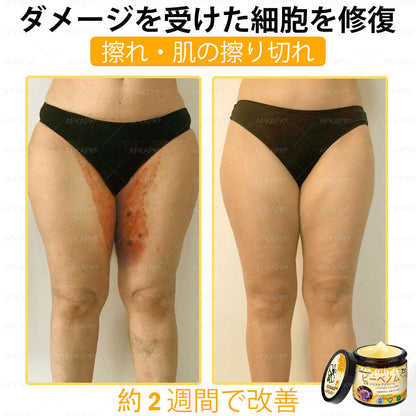 ✨💜💜APKAPK® 𝗠É𝗛𝗠É𝗥𝗘𝗚 総合クリーム🥇 皮膚の隆起に対するケアには以下が含まれます： 加齢によるシミ、傷跡、いぼ、皮膚の隆起、脂肪の塊、ニキビ、湿疹、乾癬、反転性ニキビ、しわ、皮膚の老化およびその他の問題🔥