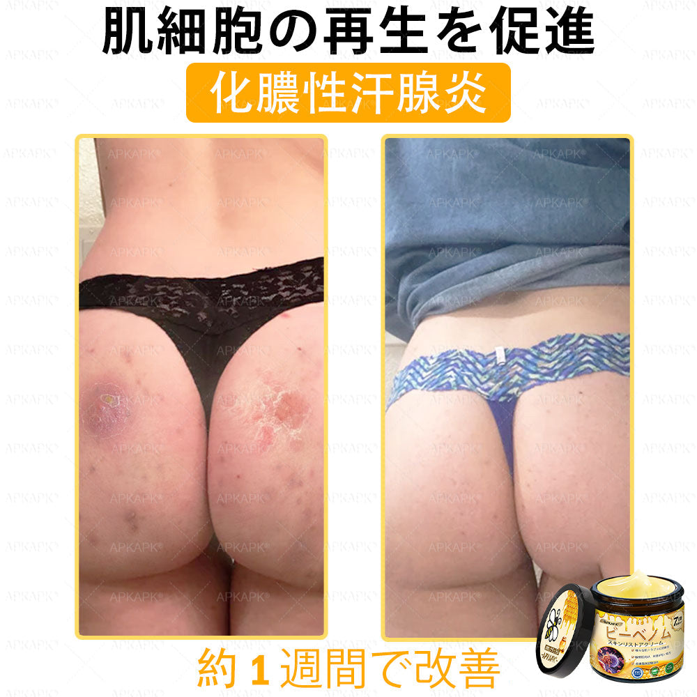 ✨💜💜APKAPK® 𝗠É𝗛𝗠É𝗥𝗘𝗚 総合クリーム🥇 皮膚の隆起に対するケアには以下が含まれます： 加齢によるシミ、傷跡、いぼ、皮膚の隆起、脂肪の塊、ニキビ、湿疹、乾癬、反転性ニキビ、しわ、皮膚の老化およびその他の問題🔥