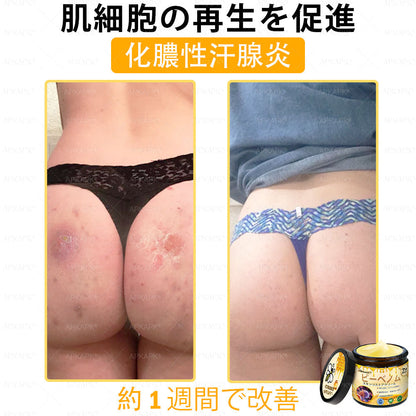 ✨💜💜APKAPK® 𝗠É𝗛𝗠É𝗥𝗘𝗚 総合クリーム🥇 皮膚の隆起に対するケアには以下が含まれます： 加齢によるシミ、傷跡、いぼ、皮膚の隆起、脂肪の塊、ニキビ、湿疹、乾癬、反転性ニキビ、しわ、皮膚の老化およびその他の問題🔥