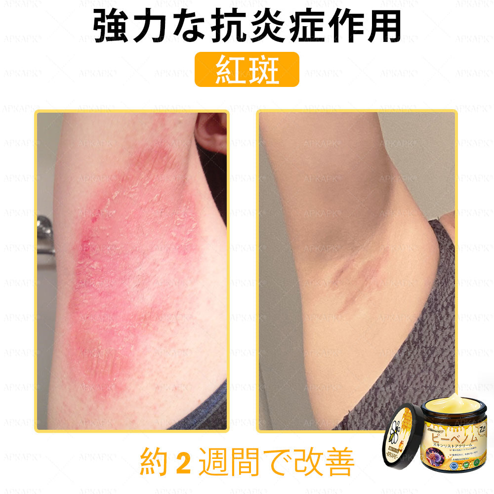 ✨💜💜APKAPK® 𝗠É𝗛𝗠É𝗥𝗘𝗚 総合クリーム🥇 皮膚の隆起に対するケアには以下が含まれます： 加齢によるシミ、傷跡、いぼ、皮膚の隆起、脂肪の塊、ニキビ、湿疹、乾癬、反転性ニキビ、しわ、皮膚の老化およびその他の問題🔥