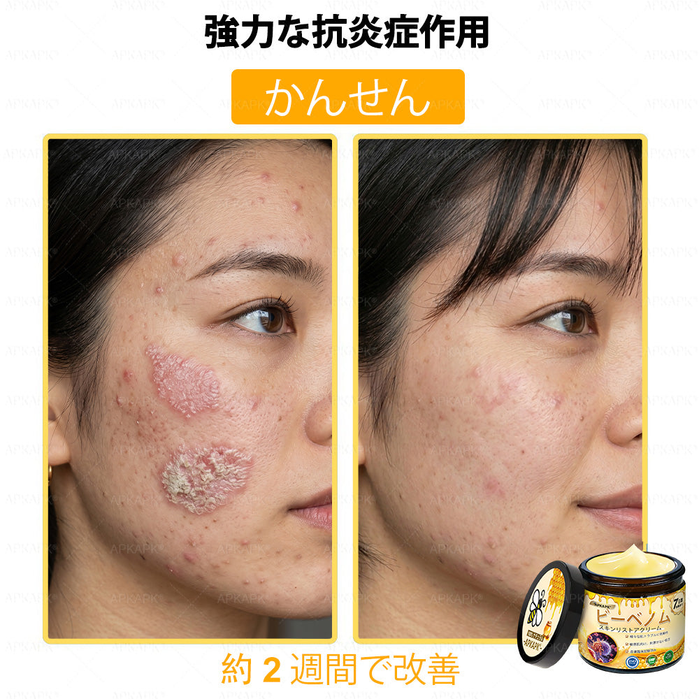 ✨💜💜APKAPK® 𝗠É𝗛𝗠É𝗥𝗘𝗚 総合クリーム🥇 皮膚の隆起に対するケアには以下が含まれます： 加齢によるシミ、傷跡、いぼ、皮膚の隆起、脂肪の塊、ニキビ、湿疹、乾癬、反転性ニキビ、しわ、皮膚の老化およびその他の問題🔥