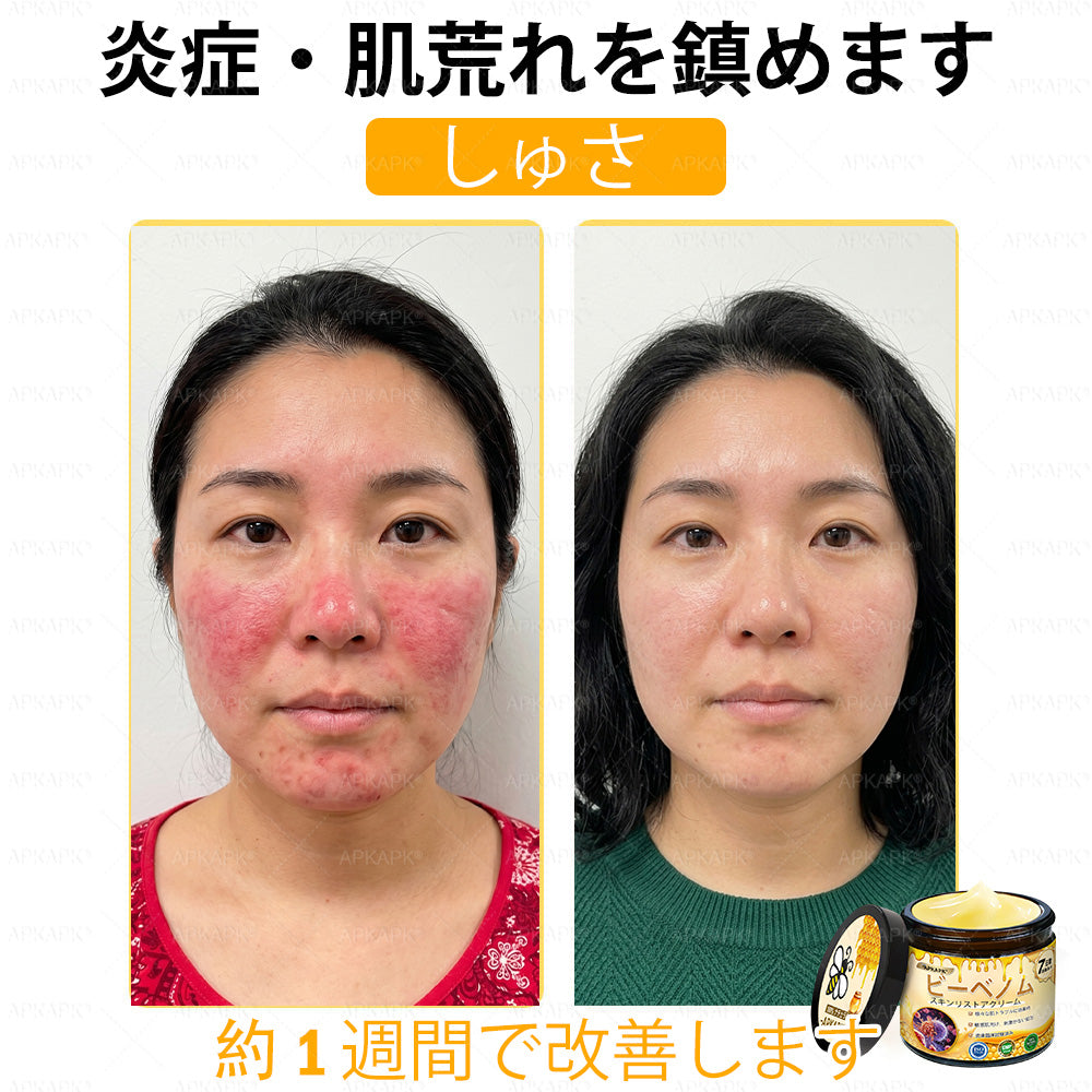 ✨💜💜APKAPK® 𝗠É𝗛𝗠É𝗥𝗘𝗚 総合クリーム🥇 皮膚の隆起に対するケアには以下が含まれます： 加齢によるシミ、傷跡、いぼ、皮膚の隆起、脂肪の塊、ニキビ、湿疹、乾癬、反転性ニキビ、しわ、皮膚の老化およびその他の問題🔥