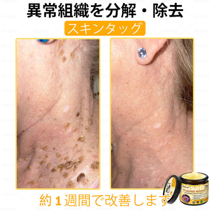 ✨💜💜APKAPK® 𝗠É𝗛𝗠É𝗥𝗘𝗚 総合クリーム🥇 皮膚の隆起に対するケアには以下が含まれます： 加齢によるシミ、傷跡、いぼ、皮膚の隆起、脂肪の塊、ニキビ、湿疹、乾癬、反転性ニキビ、しわ、皮膚の老化およびその他の問題🔥
