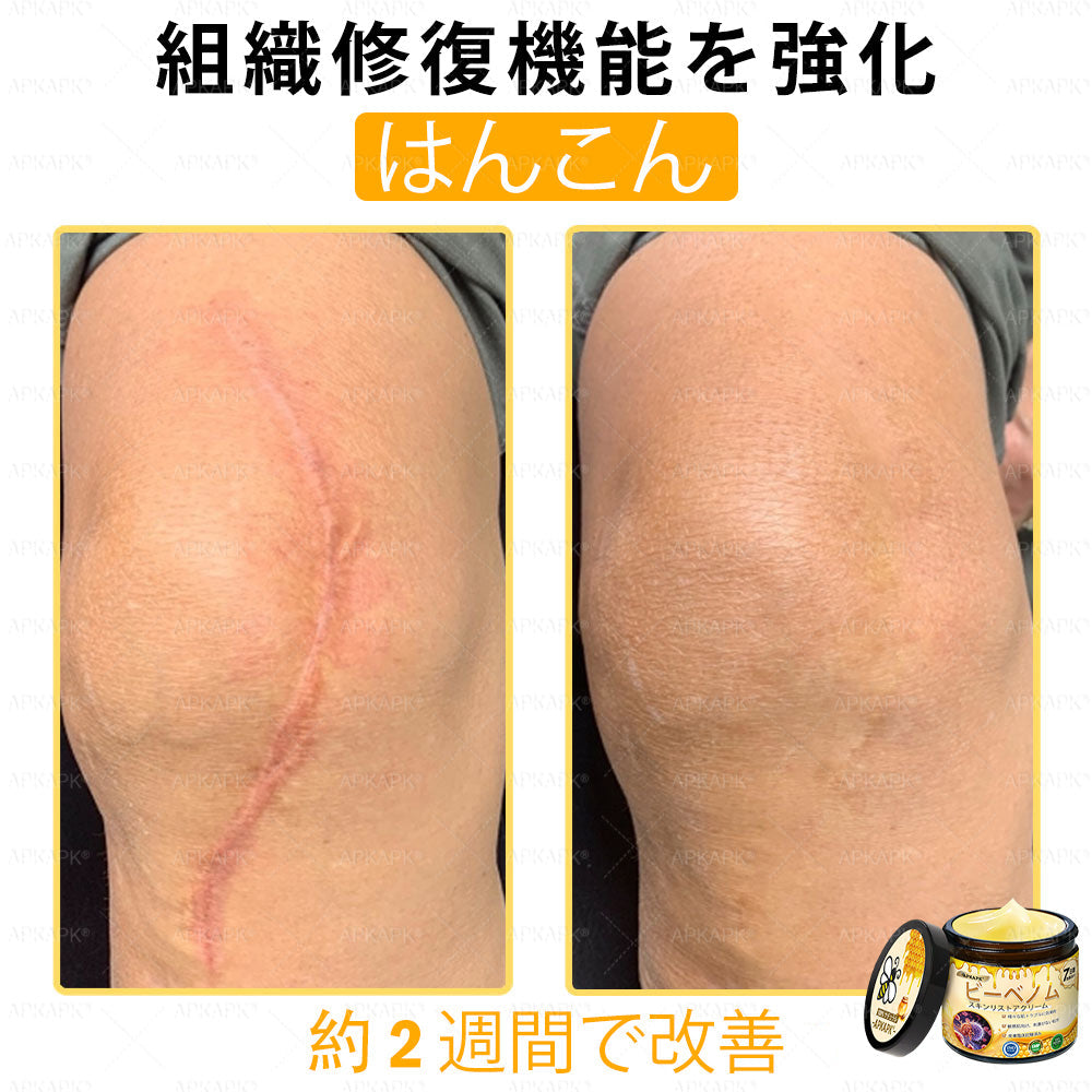 ✨💜💜APKAPK® 𝗠É𝗛𝗠É𝗥𝗘𝗚 総合クリーム🥇 皮膚の隆起に対するケアには以下が含まれます： 加齢によるシミ、傷跡、いぼ、皮膚の隆起、脂肪の塊、ニキビ、湿疹、乾癬、反転性ニキビ、しわ、皮膚の老化およびその他の問題🔥